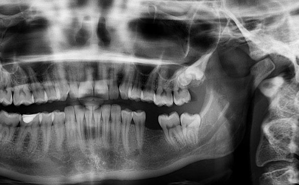Rontgenova snímka zubov a zuby