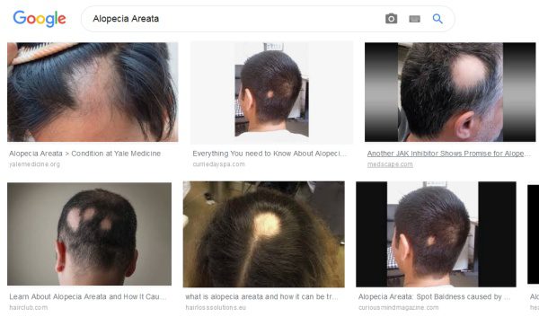 alopecia aerata